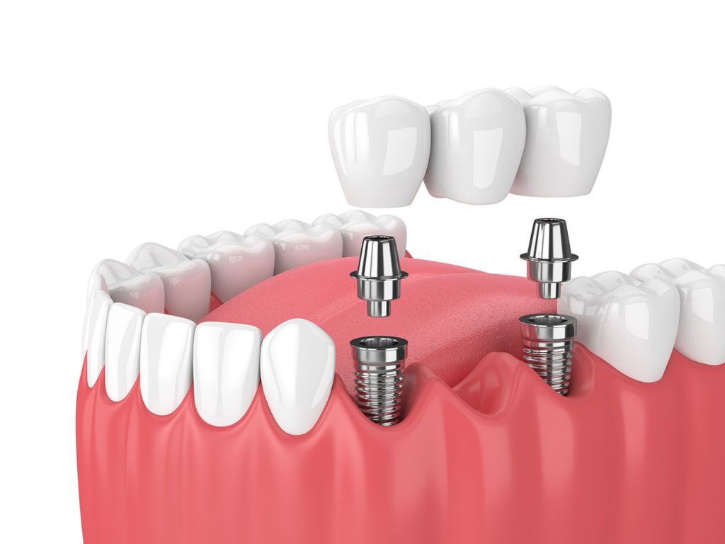 implant supported dental bridge Durham North Carolina