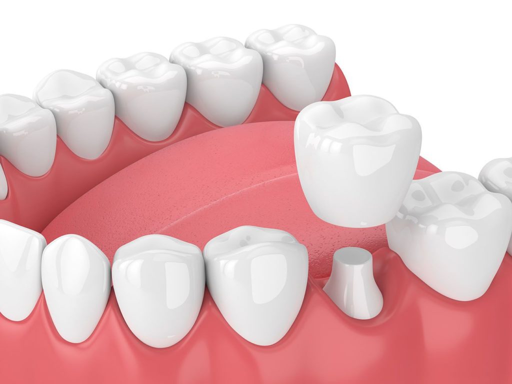 dental crown benefits Durham North Carolina