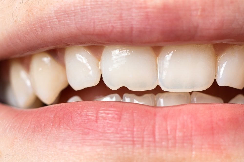 restore cosmetic dental damage in Durham North Carolina