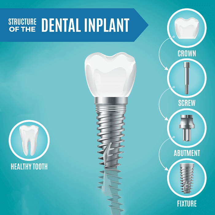 What Makes Up a Dental Implant