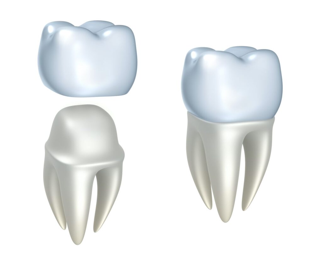 Know the Dental Crown Process