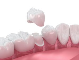 What Exactly Is a Dental Crown? in Durham, NC
